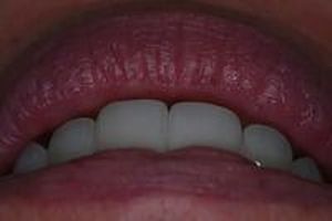 скърцане със зъби - 65631 постижения