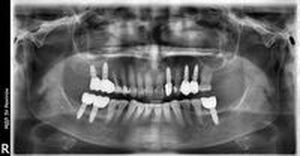 скърцане със зъби - 61256 типа