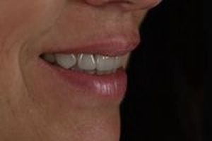 зъбни импланти - 6538 предложения