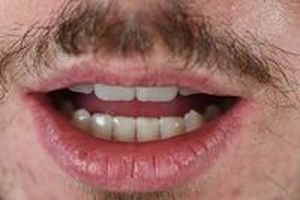 зъбни импланти - 19855 предложения