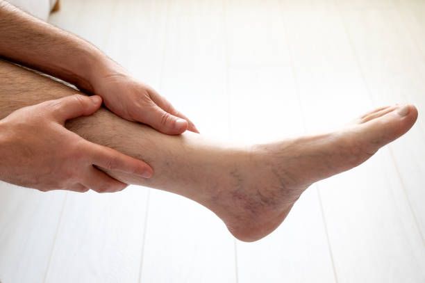 лечение на разширени вени - 58939 новини | medicabilis.eu лечение на разширени вени - 59278 новини